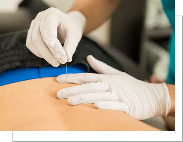 Cropped image of male physiotherapist doing dry puncture on the back of patient in clinic