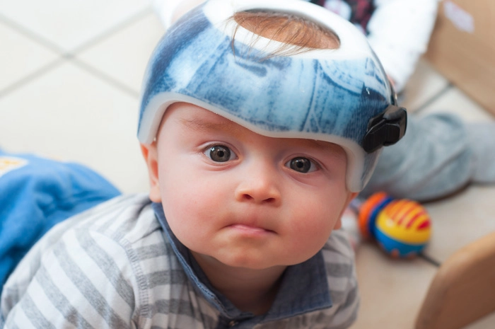 child in an orthopedic helmet